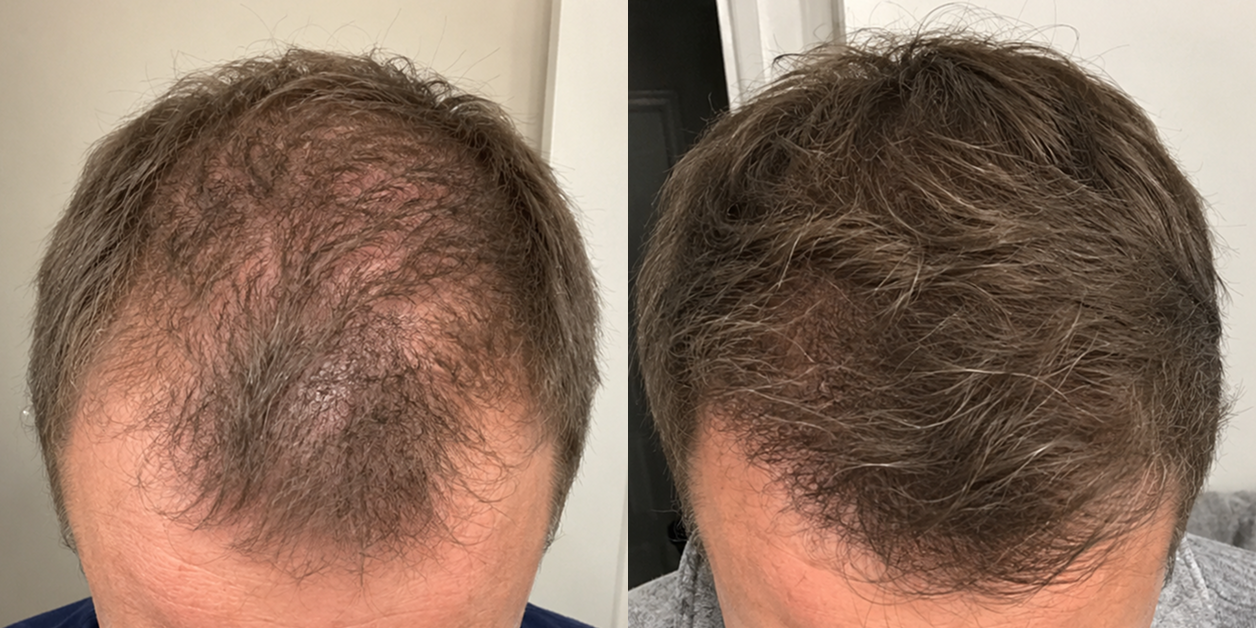 A side-by-side comparison of a man's head, showing thinning hair on the left and thicker hair on the right.