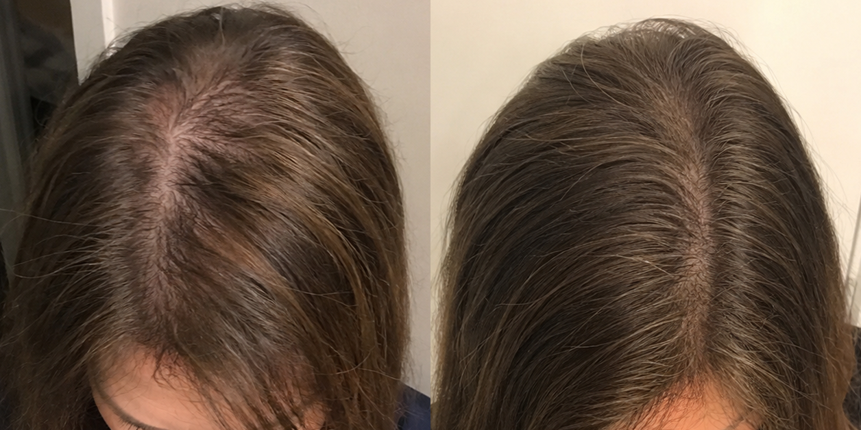 A before and after comparison of a woman's hair part, showing increased fullness and coverage on the right.