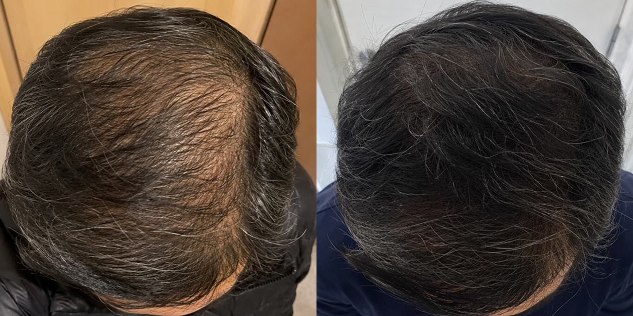 A before and after comparison of a person's hair, showing increased thickness and coverage on the right.