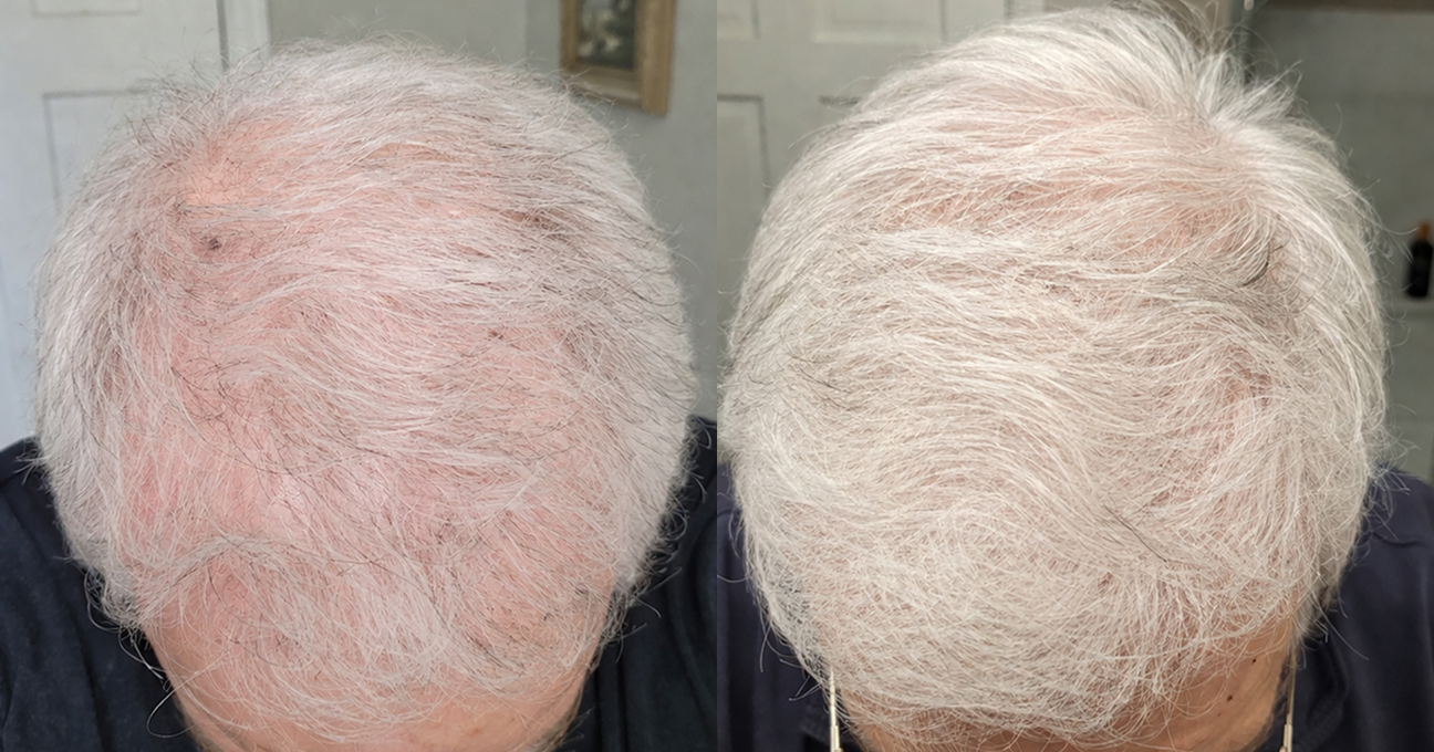 A side-by-side before and after comparison of hair regrowth on the top of a person's head.