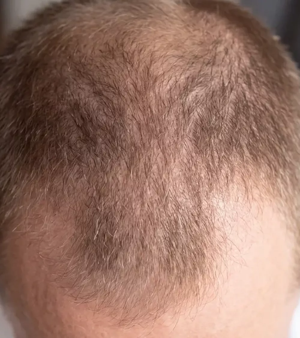 A close-up, top-down view of a man's head showing thinning light brown hair and a receding hairline.
