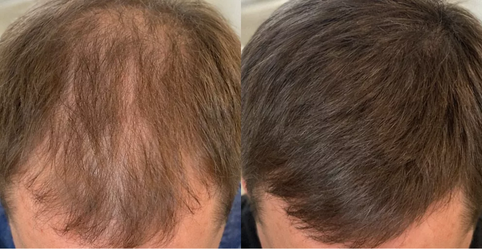 A before and after comparison showing a man's thinning hair on the left and fuller hair on the right.
