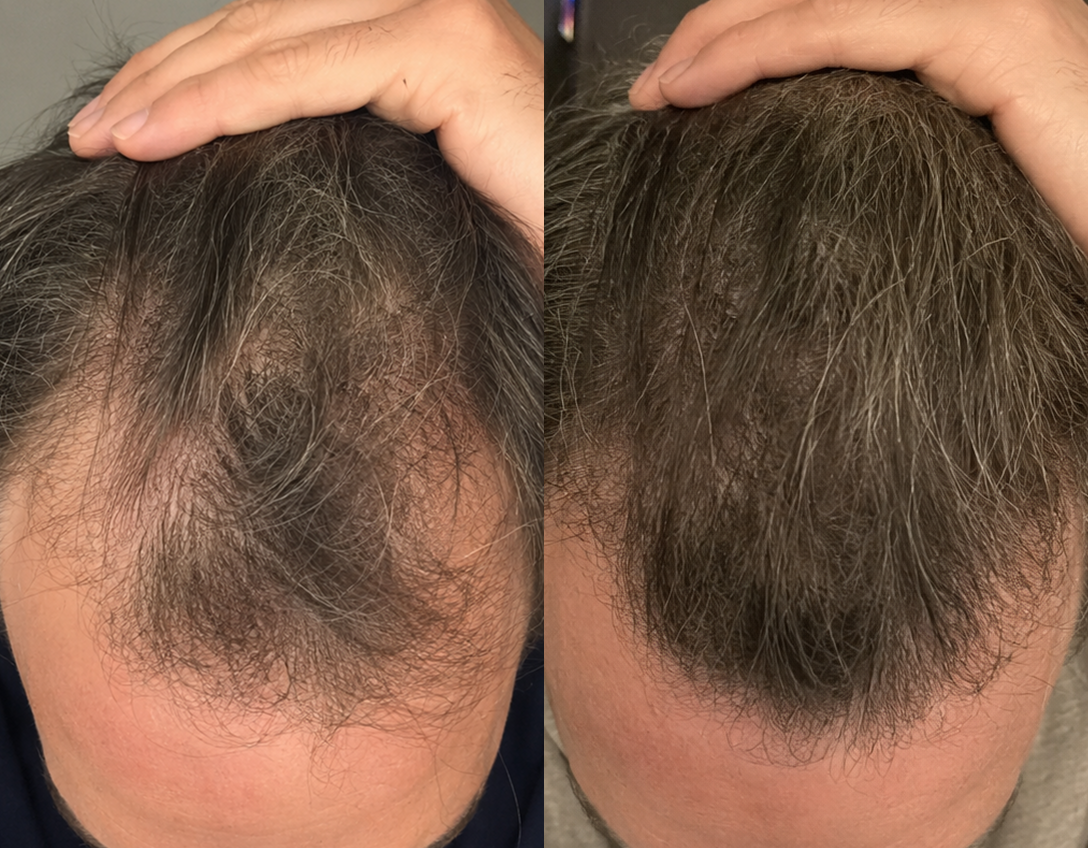 A before and after comparison showing a man's hairline with less hair on the left and more on the right.
