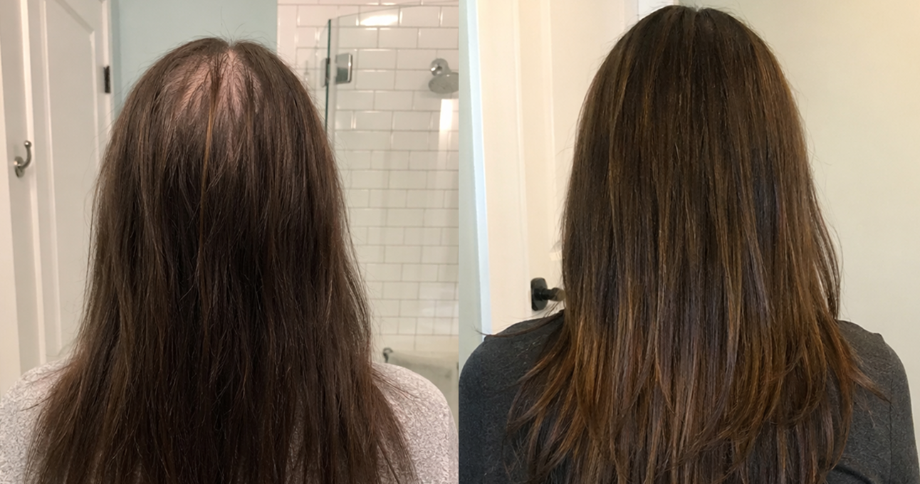 A before and after image showing the back of a woman's head with thinning and then fuller-looking hair.