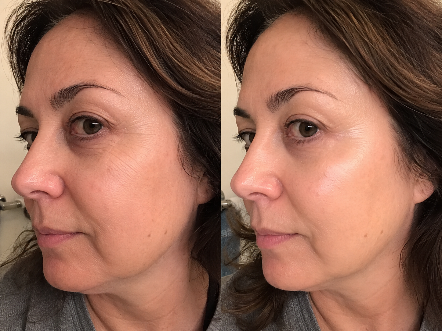 A side-by-side before and after image showing a woman's face with a visible reduction in wrinkles.