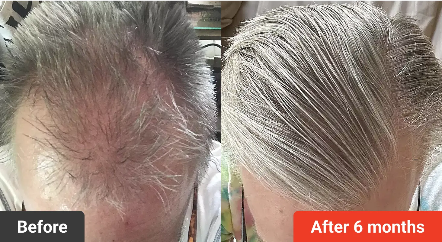 Comparison of hair before and after six months of treatment.