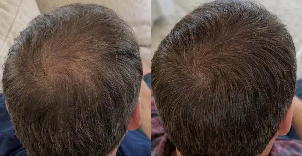 A before and after comparison of hair on the crown of a man's head, showing increased fullness.
