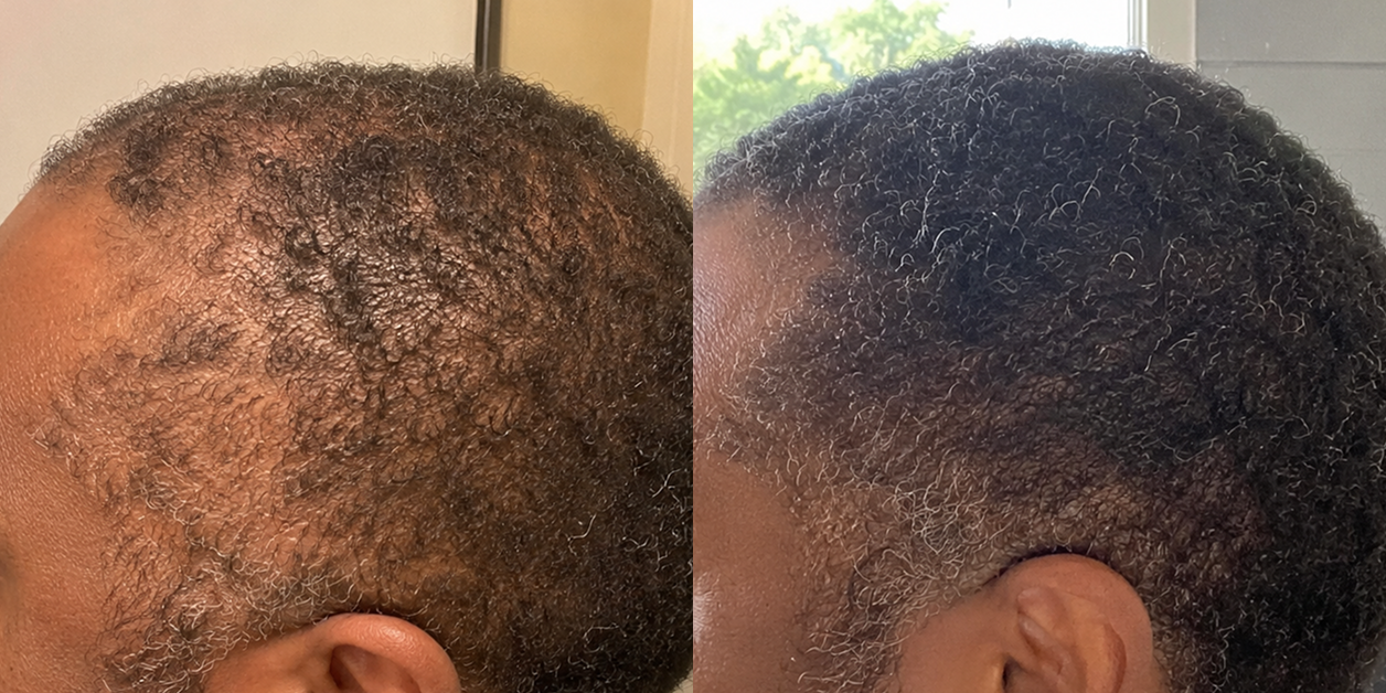 A split image showing a person's thinning hair on the left and thicker, fuller hair on the right.