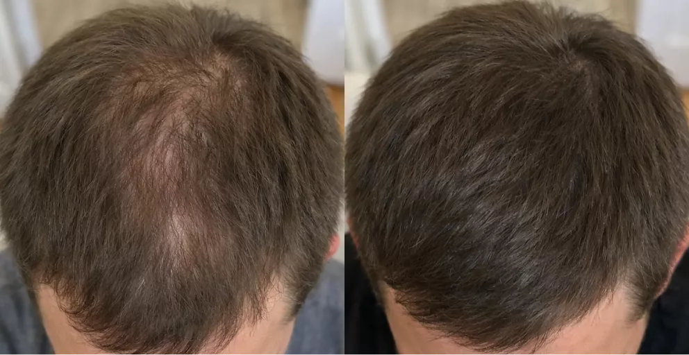 A before and after comparison of a man's hair, showing increased thickness and coverage on the crown.
