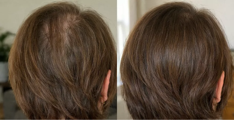 A before and after image showing the back of a head with thinning hair on the left and fuller hair on the right.