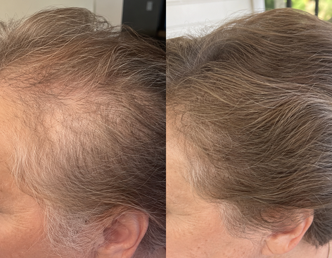 A before-and-after comparison of a person's scalp, showing thinning hair on the left and thicker hair on the right.
