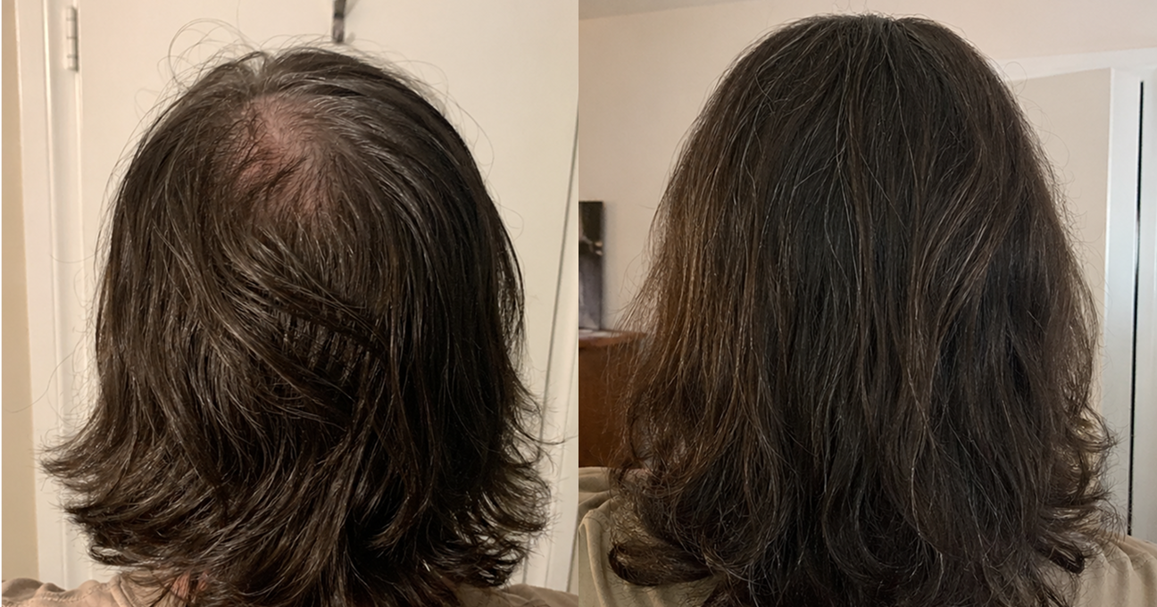 A before and after image showing the back of a person's head with fuller-looking hair on the right.
