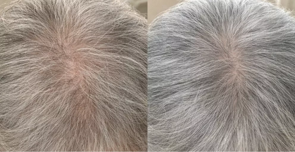 A before-and-after comparison of the top of a head with grey hair, showing it becoming thicker.