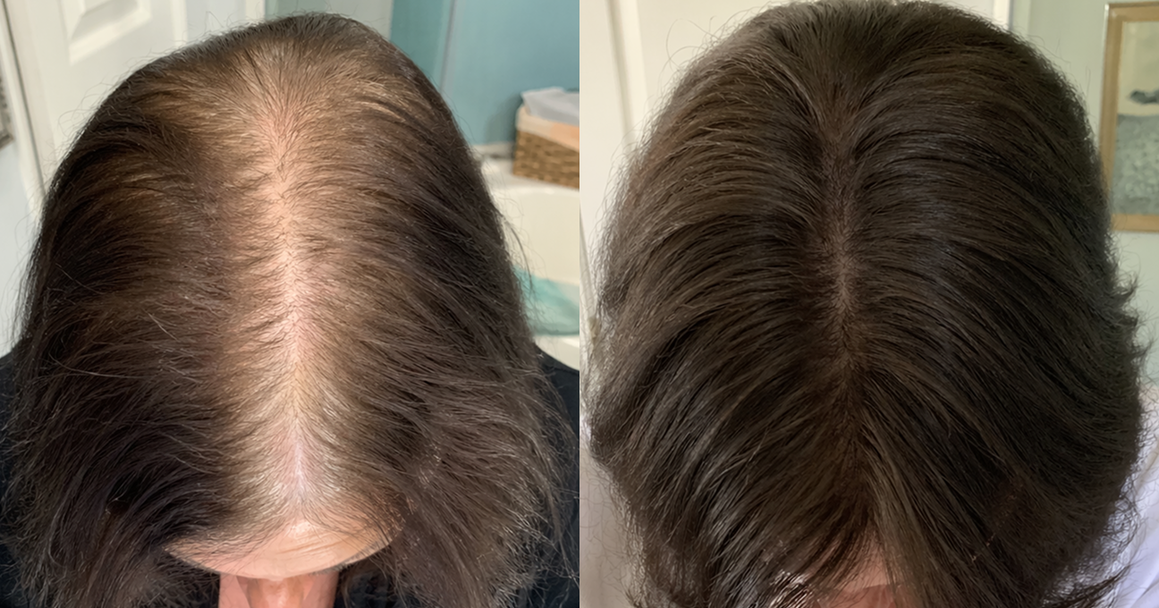 A before-and-after image of a person's scalp, showing thinning hair on the left and fuller hair on the right.