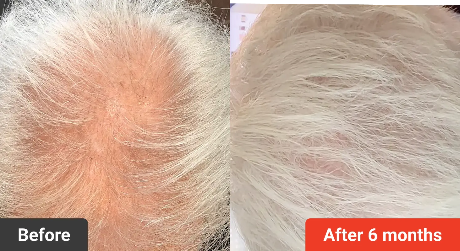 Comparison of scalp before and after hair growth treatment.