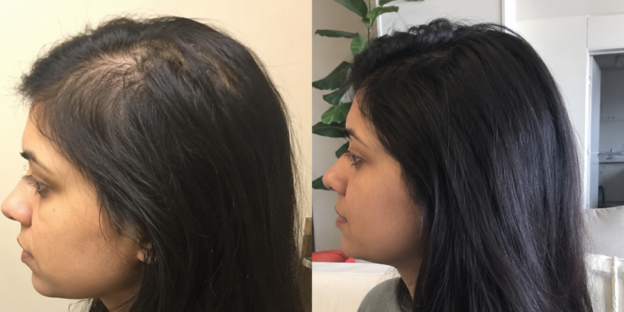 A before and after comparison of a woman's profile showing hair regrowth along her hairline and part.