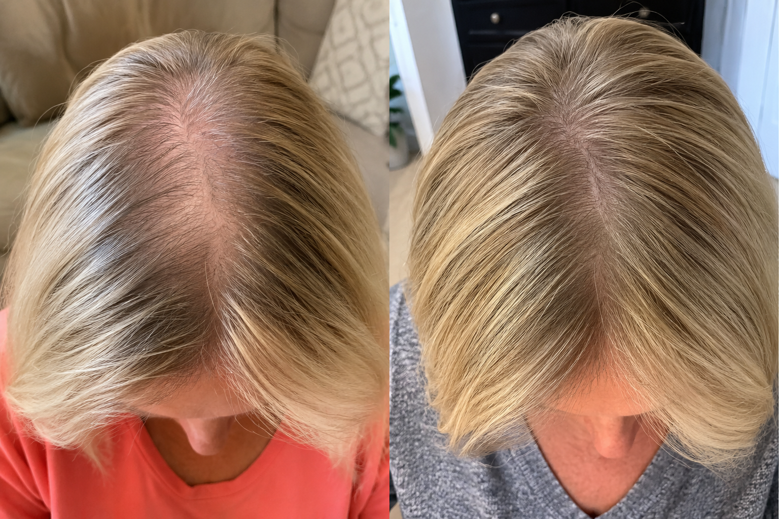 A before-and-after comparison of a woman's scalp, showing an increase in blonde hair fullness and coverage.