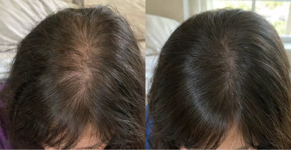 A side-by-side comparison of a person's scalp, showing thinner hair on the left and fuller hair on the right.