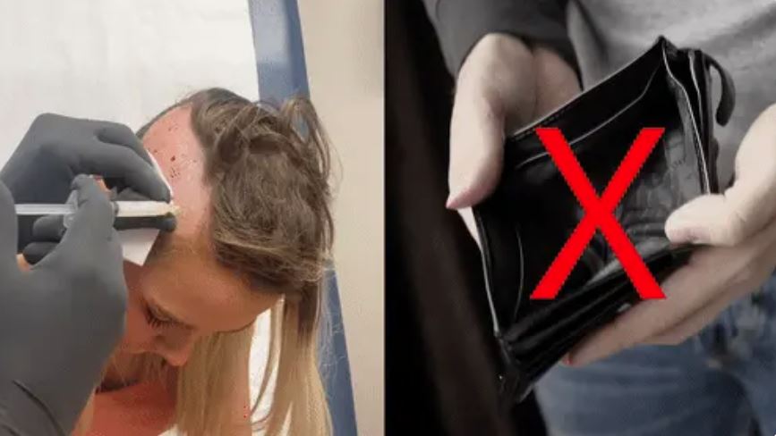 A split image showing a hair transplant procedure on the left and an empty wallet on the right.