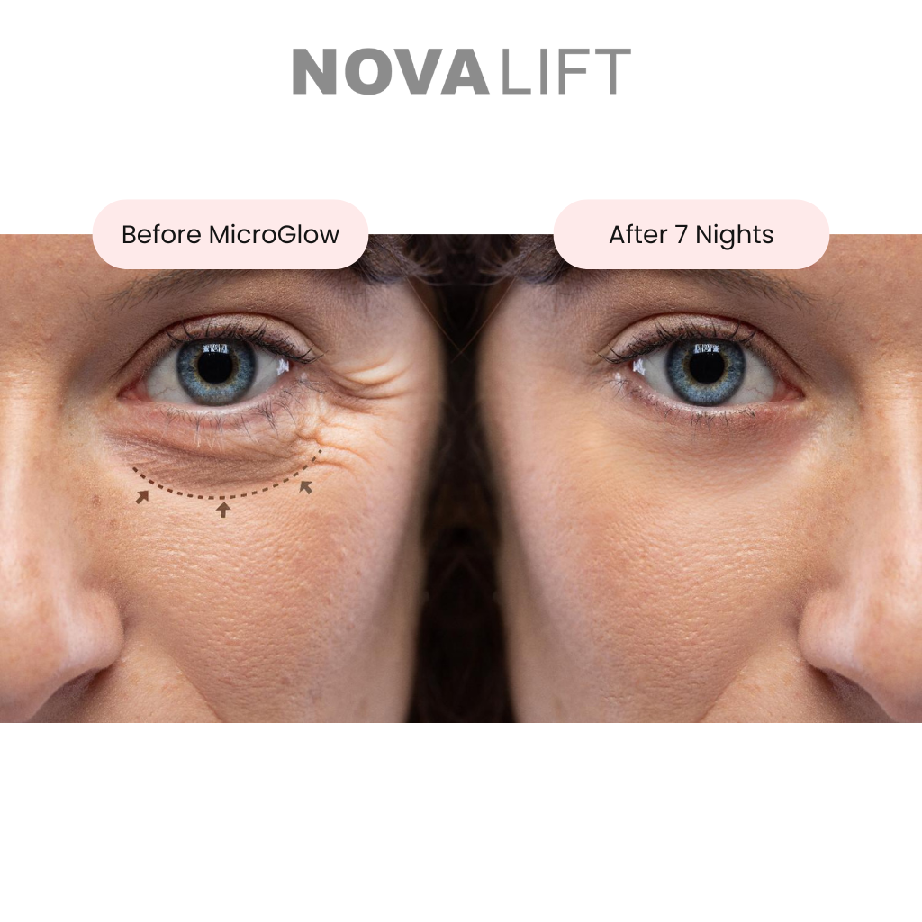 Side-by-side comparison of an eye area before and after treatment, showing reduced wrinkles.