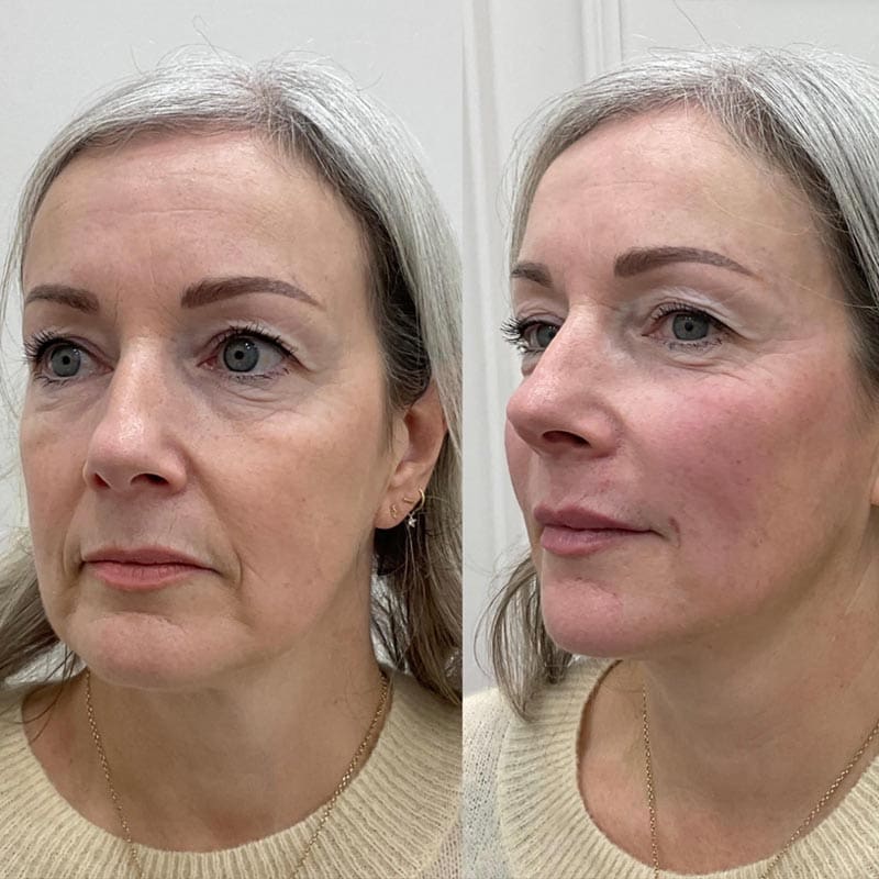 A side-by-side comparison of a woman's face, showing a frontal view and a three-quarter profile view.