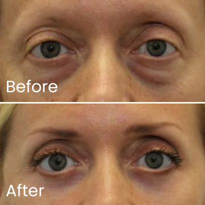 Close-up of eyes showing 'Before' and 'After' effects with noticeable differences.