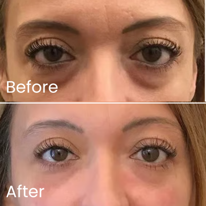 Close-up of eyes with 'Before' and 'After' showing reduced under-eye bags.