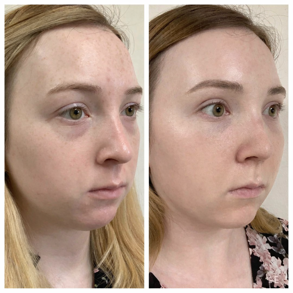 A before-and-after split image of a woman's face, showing clearer, more even skin on the right.