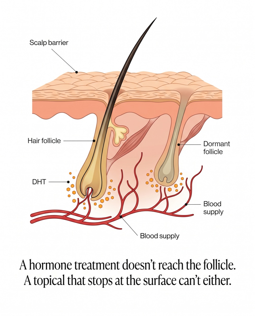 Cross-section of a hair follicle: scalp barrier, dormant follicle, DHT, blood supply
