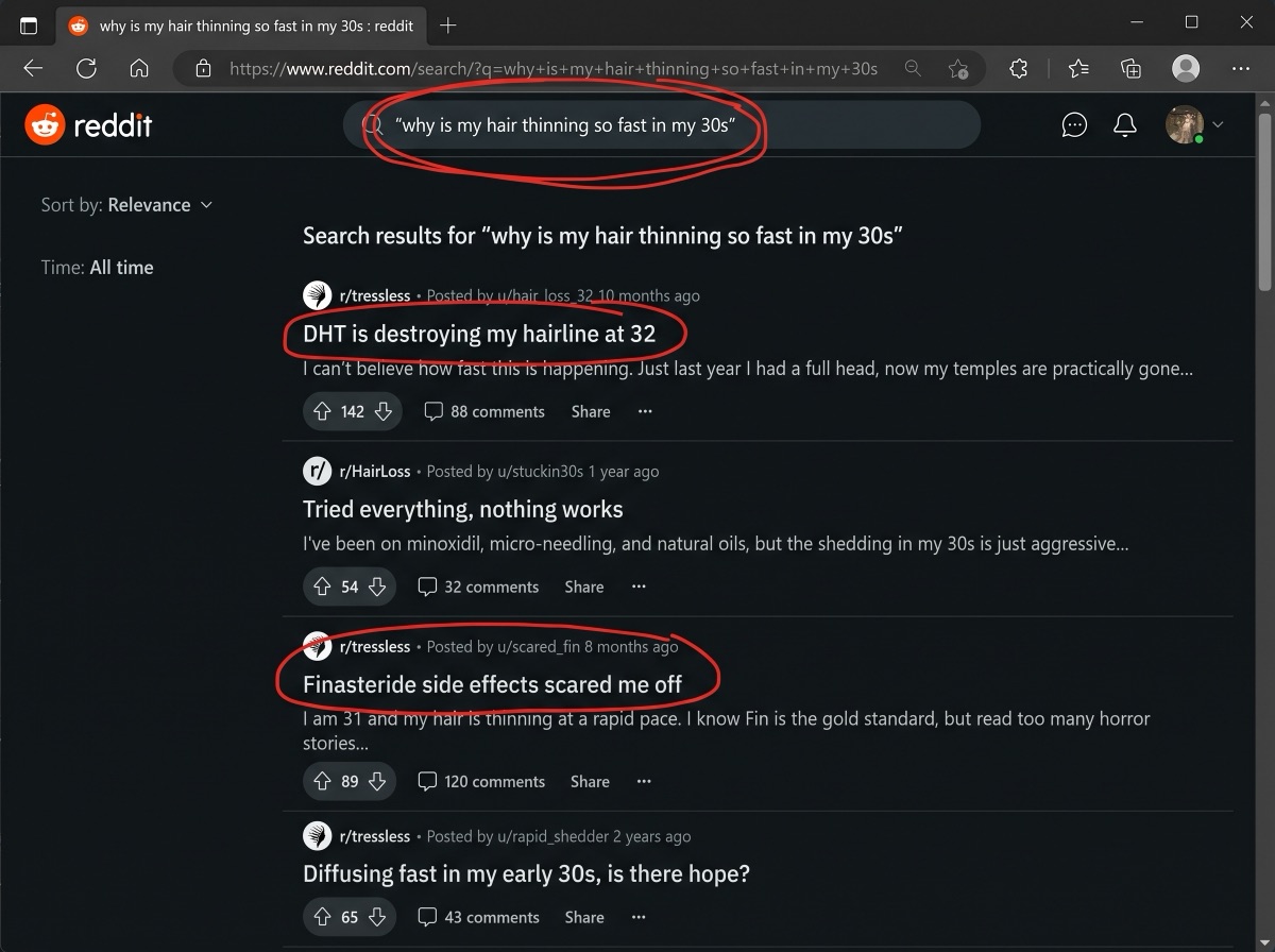 Reddit search results for thinning hair