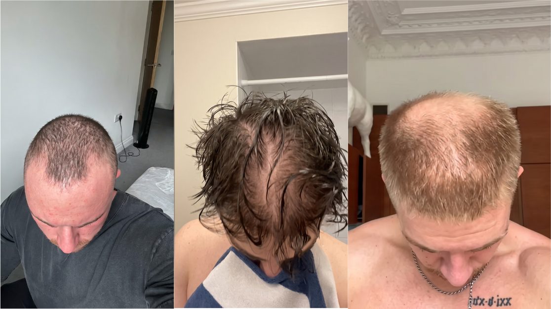 Before: three men with thinning hair
