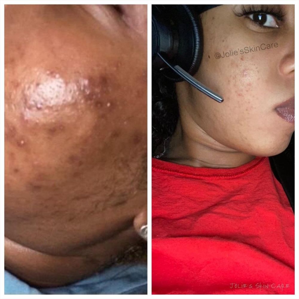 Side-by-side comparison of facial skin before and after treatment.