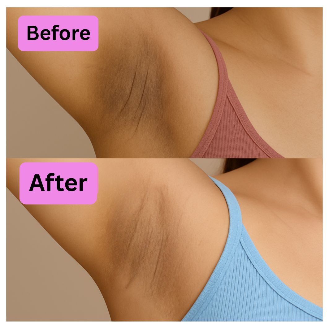 Before and after comparison of underarm skin tone improvement.