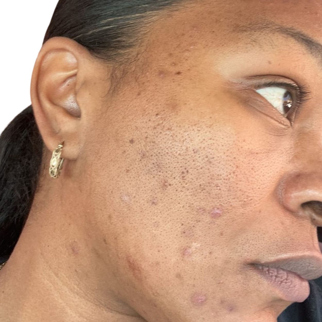 Close-up of a person's cheek with acne and blemishes.