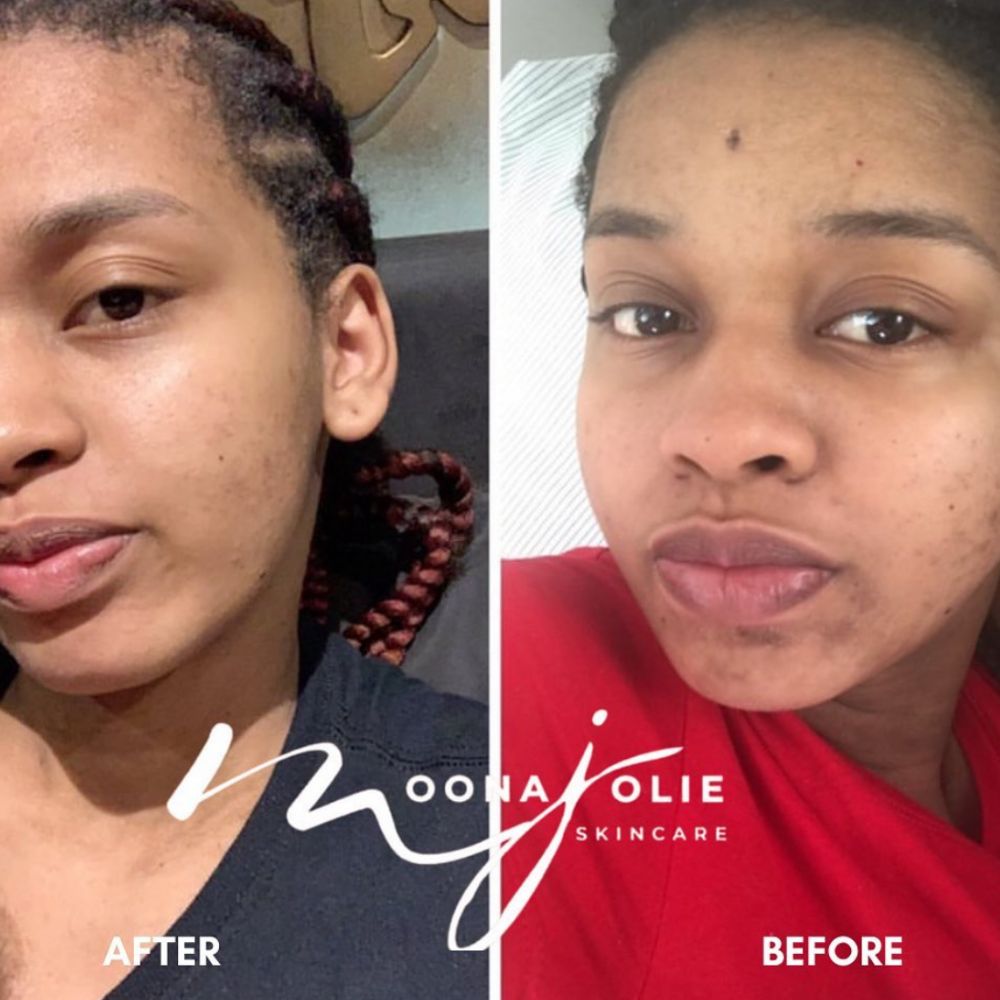 Side-by-side comparison of a woman's face before and after skincare treatment.