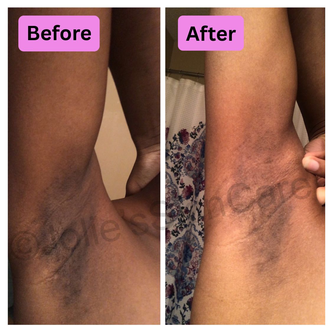 Side-by-side comparison of underarm skin labeled 'Before' and 'After'.