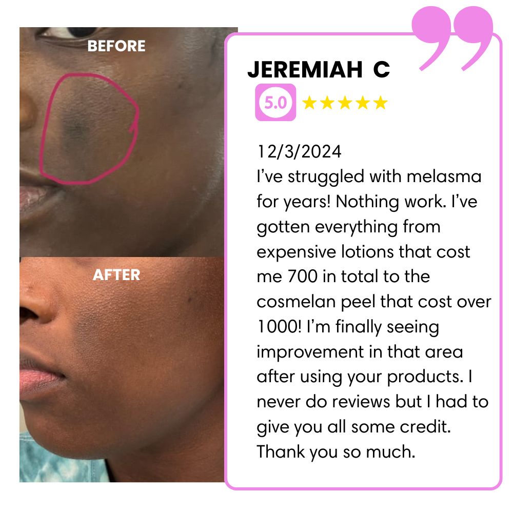 Before and after images of skin treatment with a testimonial.