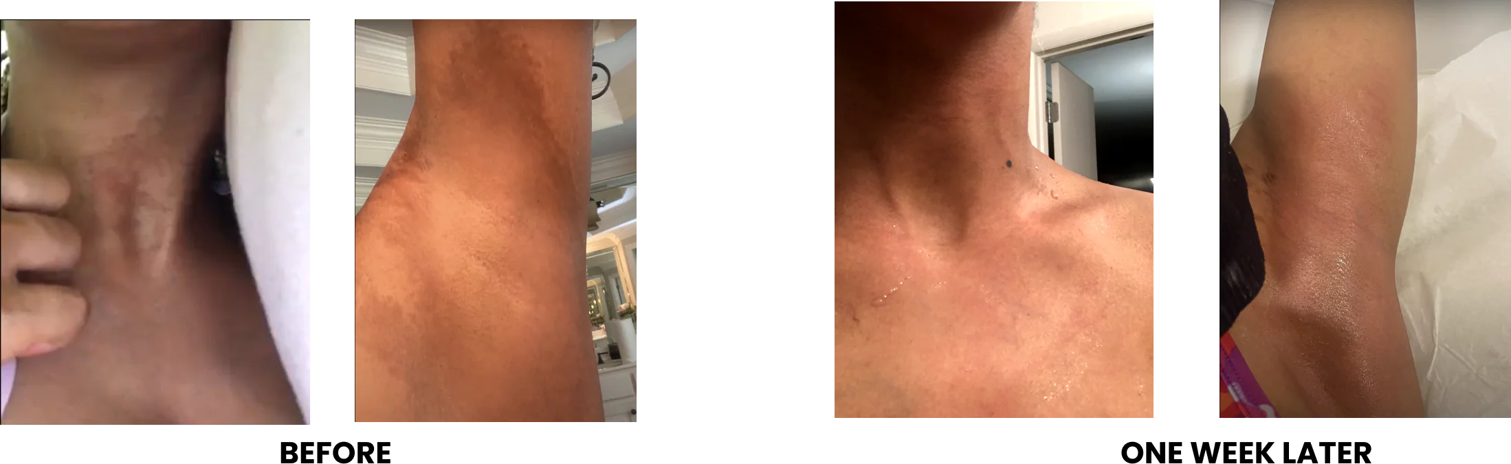 Comparison of skin condition on neck and underarm before and after one week.