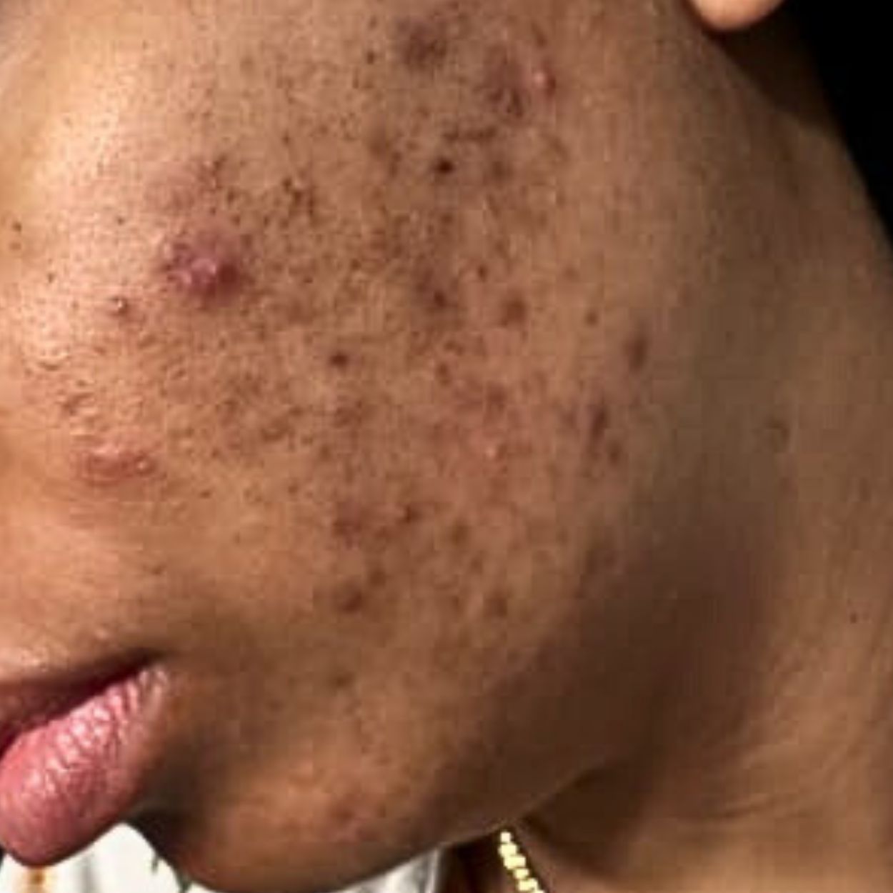 Close-up of a person's cheek with acne and dark spots.