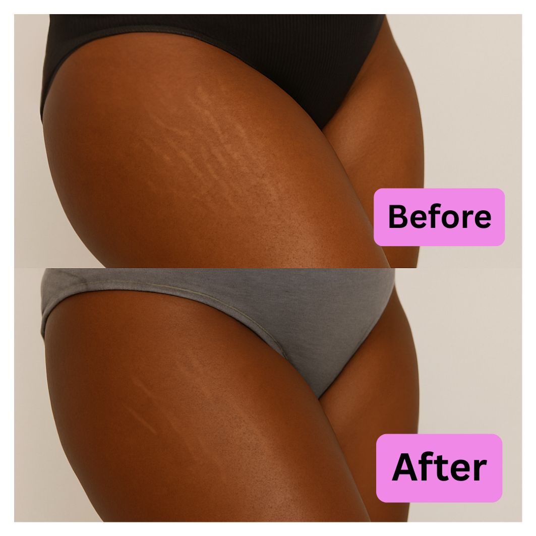 Before and after comparison of stretch marks on thighs.