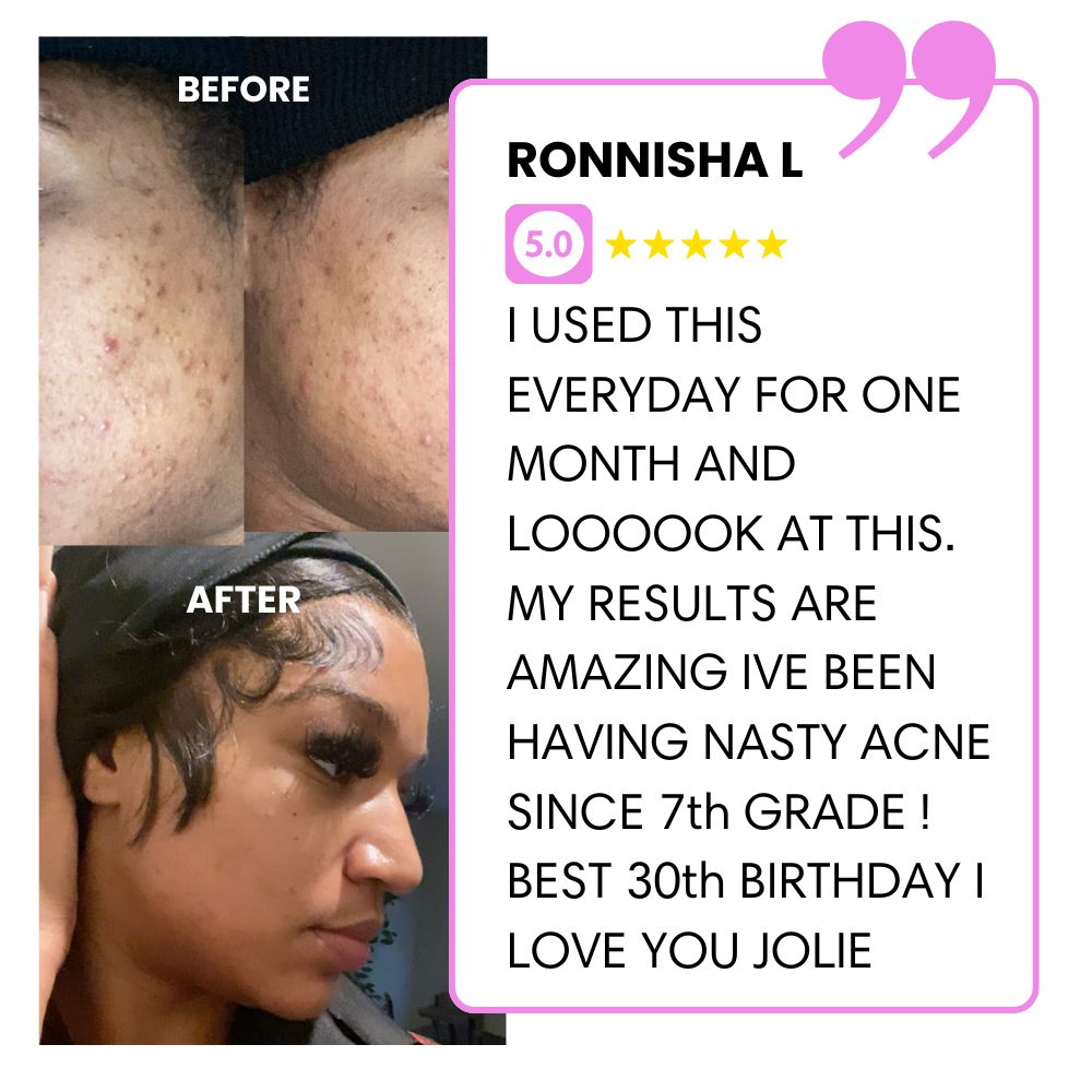 Before and after acne treatment photos with a positive testimonial.