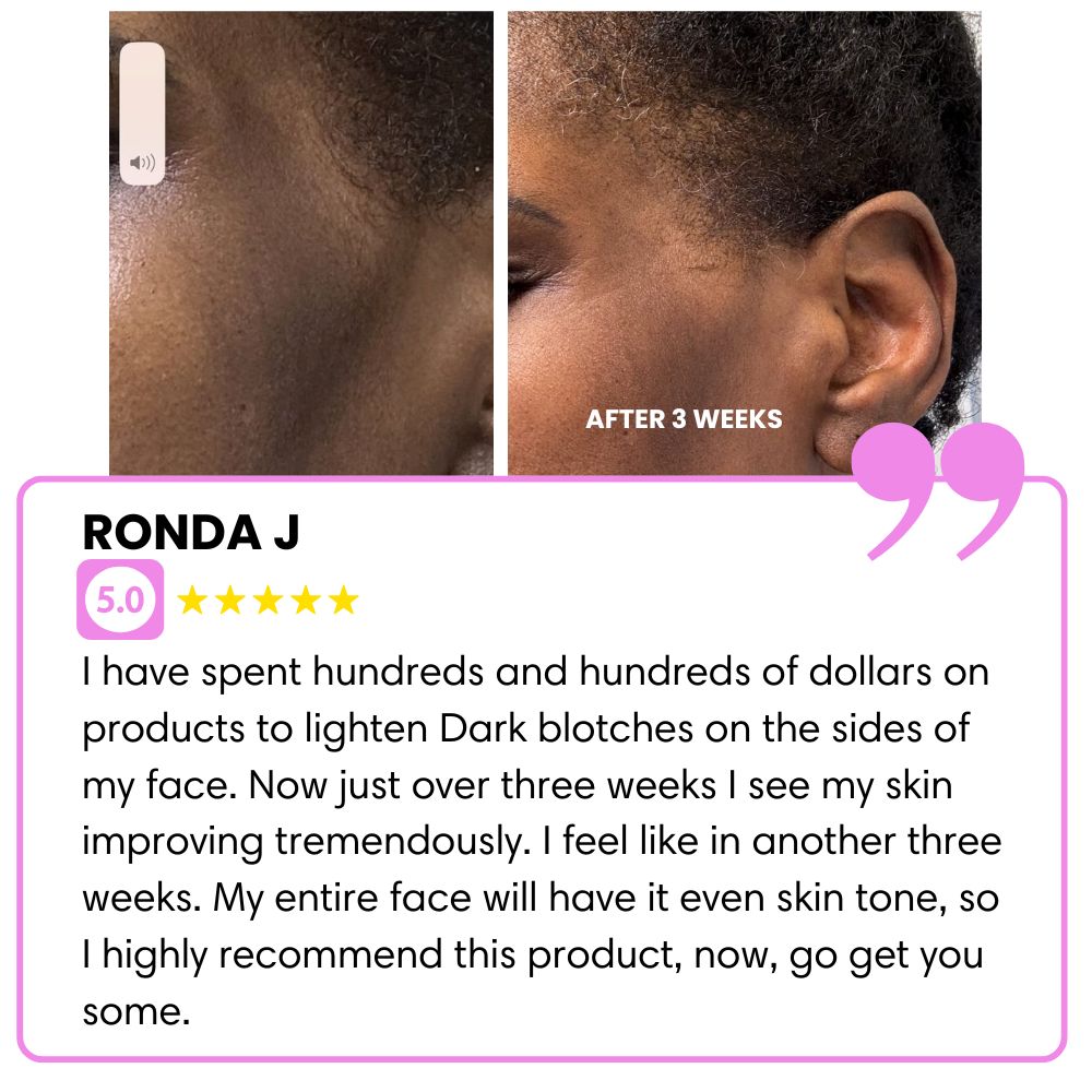 Before and after skin treatment comparison with a positive review.