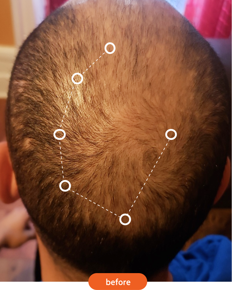 The back of a man's head with thinning hair on the crown, marked with circles and labeled 'before'.