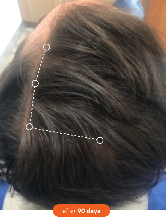 A close-up of a person's scalp showing hair regrowth at the hairline after 90 days.