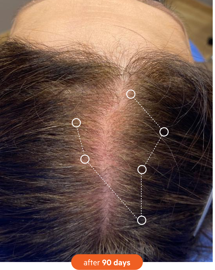 A close-up, top-down view of a scalp with brown hair, parted in the middle, labeled 'after 90 days'.
