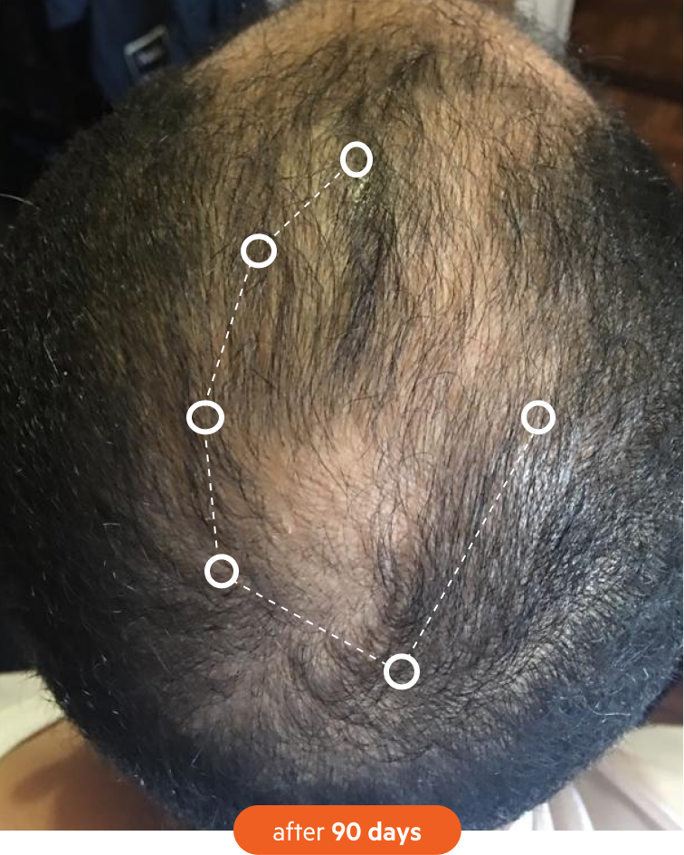 A close-up view of the top of a person's head with thinning hair, marked with a dotted line.
