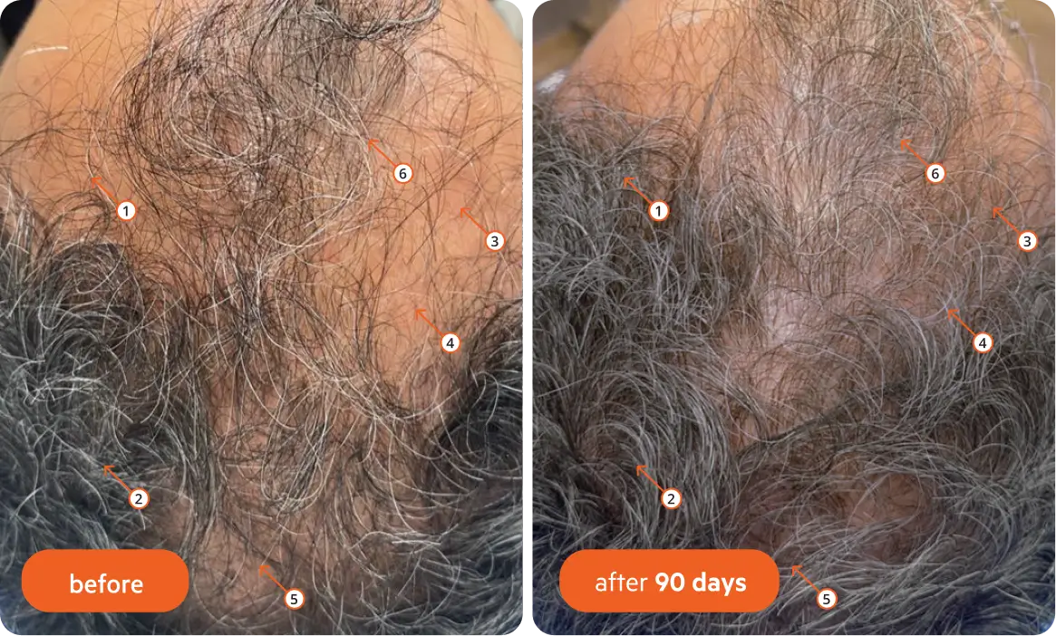 Side-by-side comparison of scalp before and after 90 days, showing hair growth.