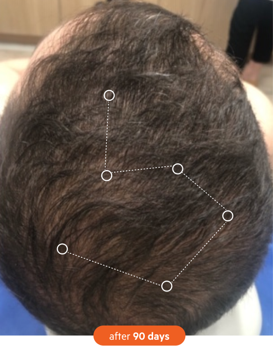 A top-down view of a person's dark, thinning hair after 90 days, with a graphic overlay highlighting an area.