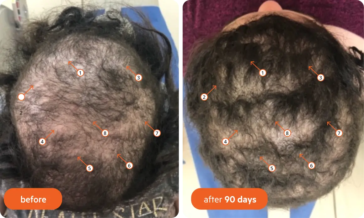 Comparison of hair growth before and after 90 days, with numbered arrows indicating changes.