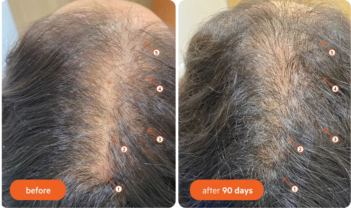 Comparison of hair growth before and after 90 days.